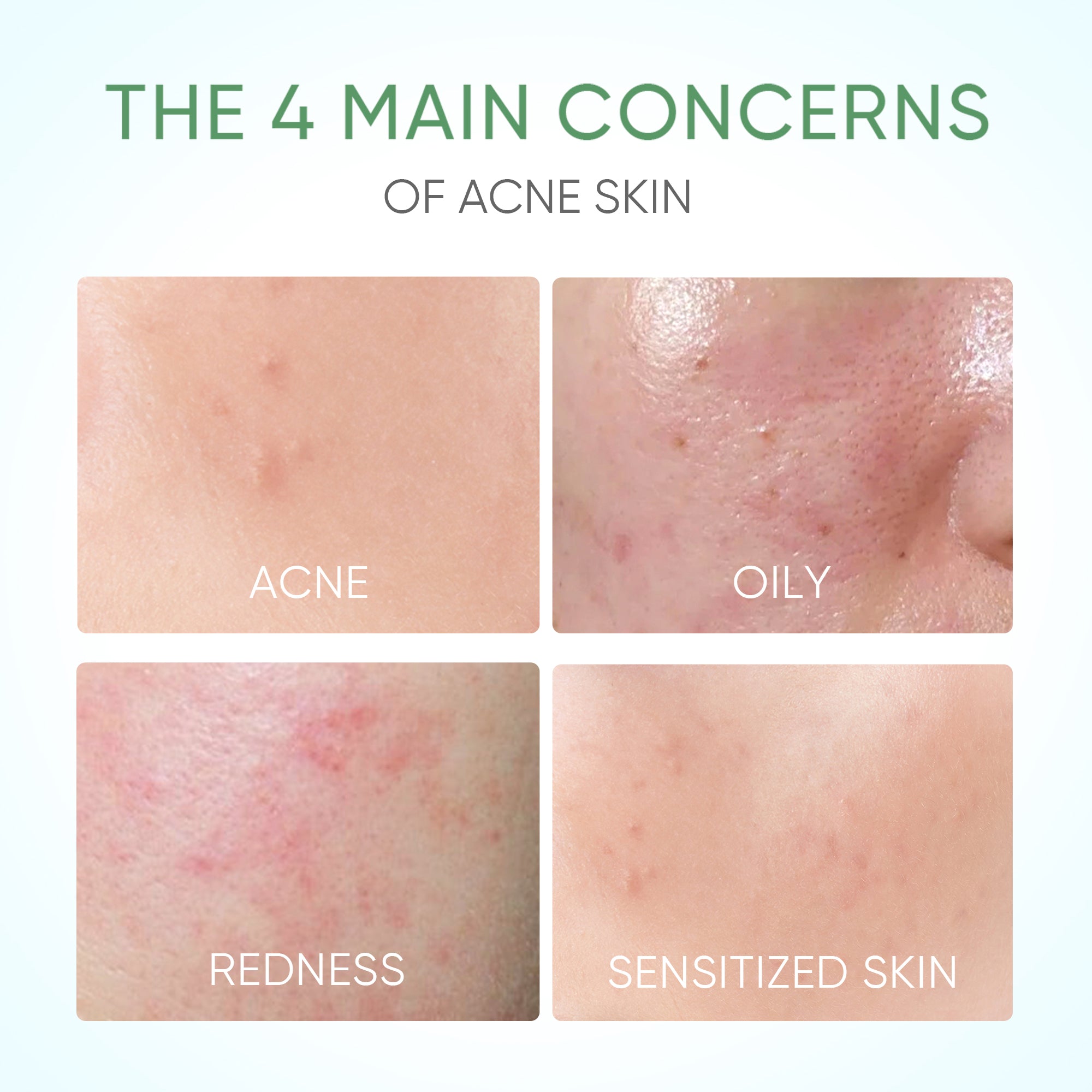 Pure Centella Acne Calming Toner 80ml for Sensitive & Acne-Prone Skin