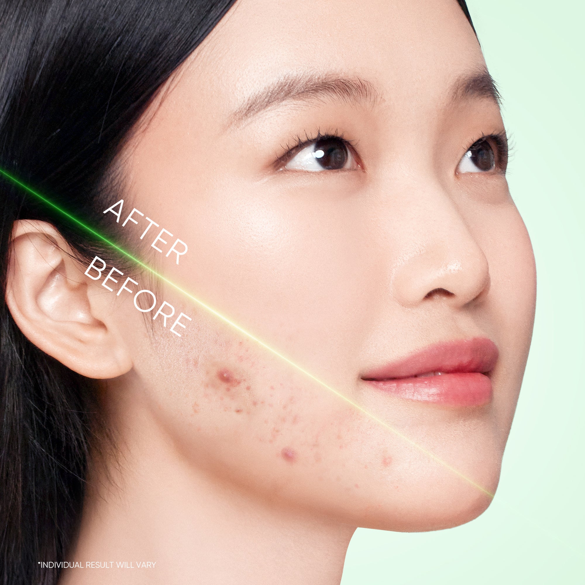 3X Acid Akne Gel-Reinigungsmittel