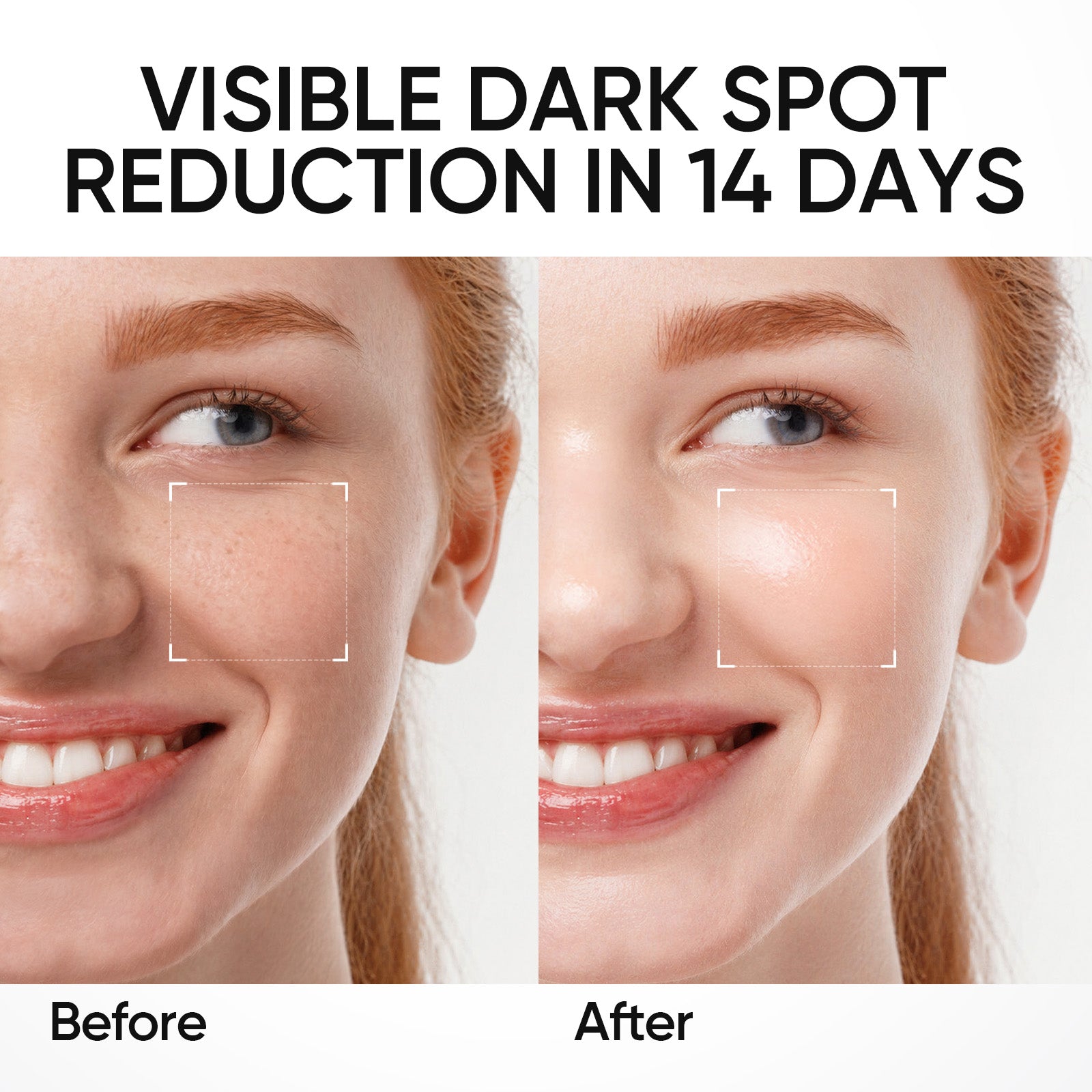 Symwhite 377 Fleckenreduzierendes Serum
