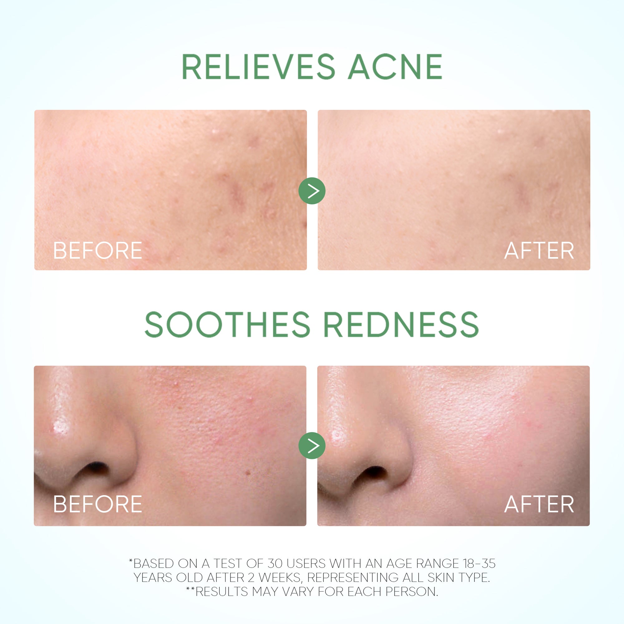 Pure Centella Acne Calming Toner 80ml for Sensitive & Acne-Prone Skin