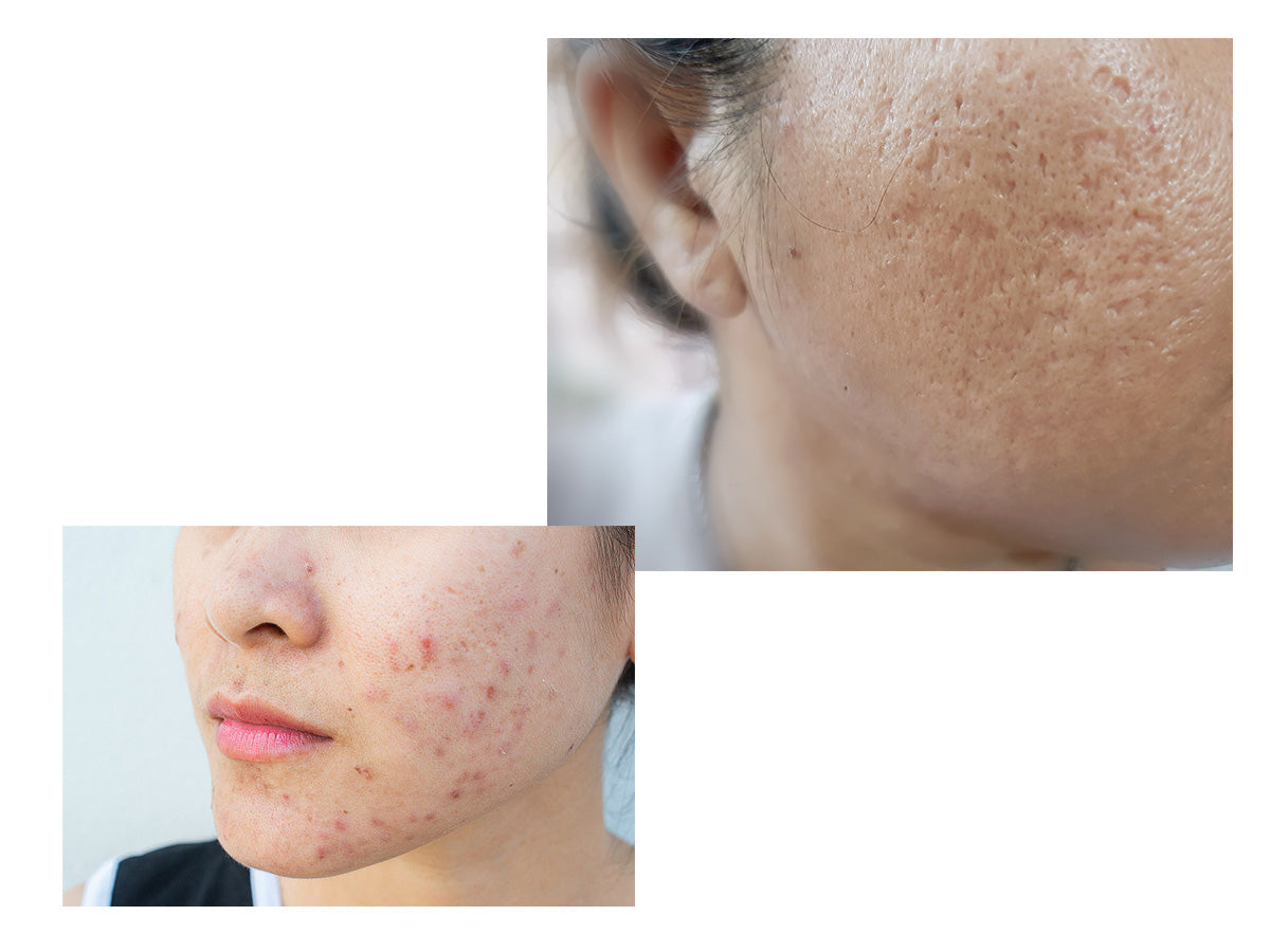 Common signs of a stressed skin barrier including dryness and flaking