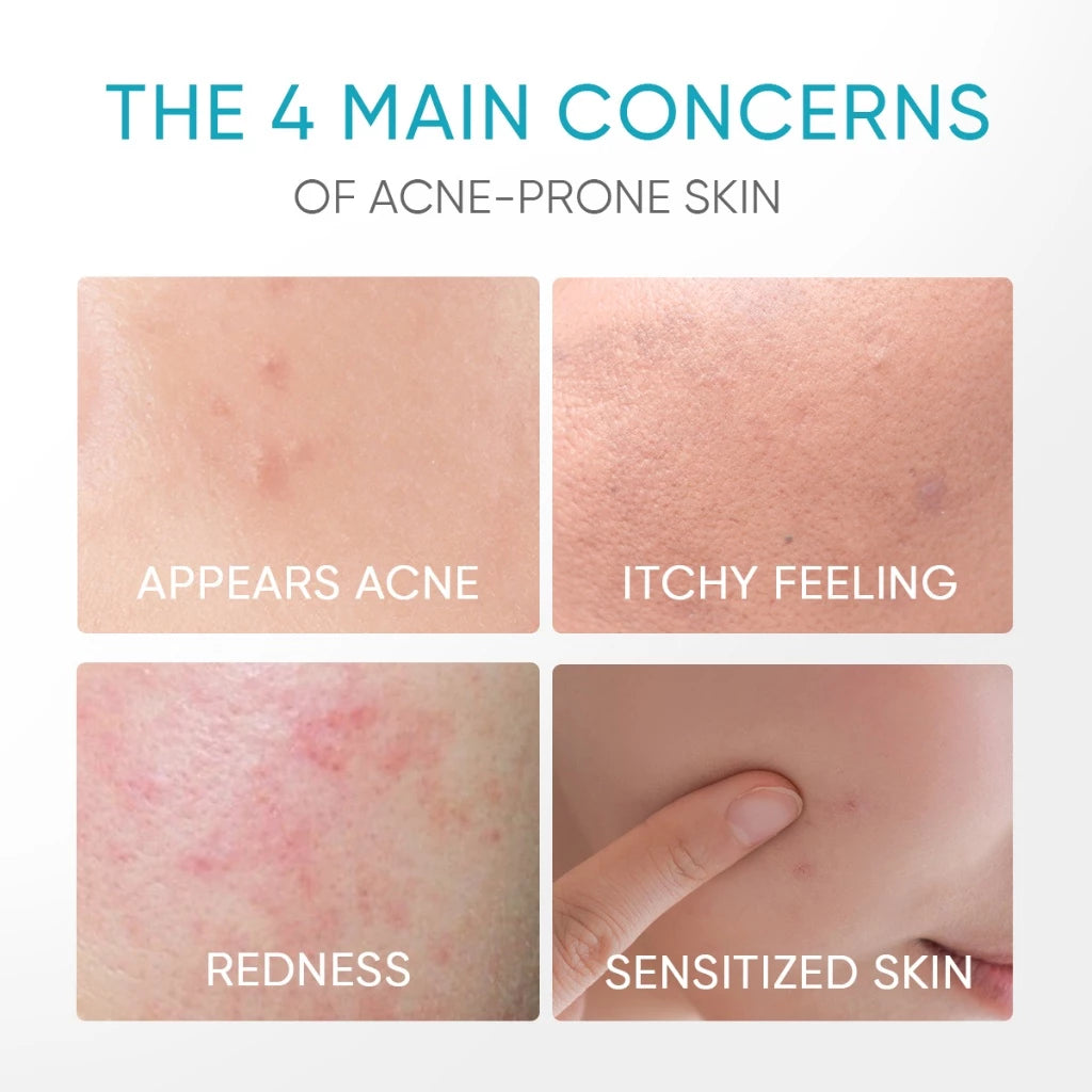 Gel calmante para el acné con 5 % de pantenol